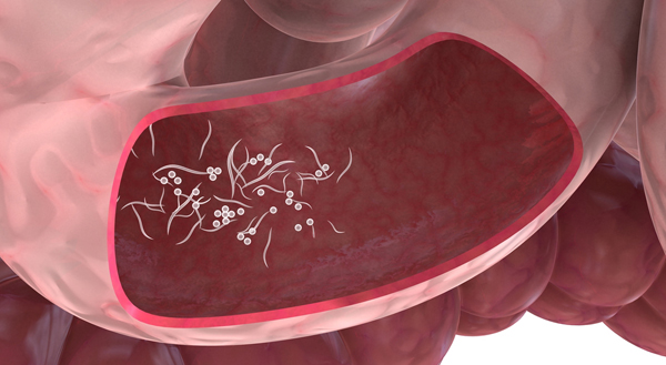 Аскаридоз - как заражается человек, признаки и симптомы